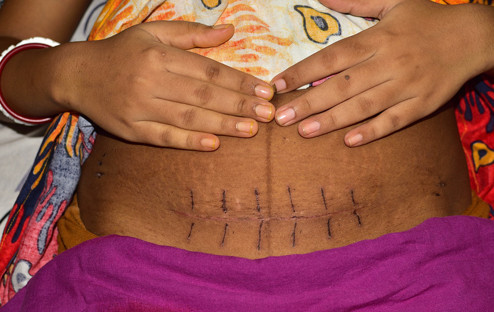 A woman showing her C-section scar (Dreamstime/SOMNATH MAHATA)
