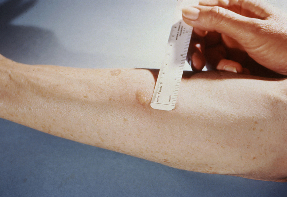A patient shows a positive reaction to the Mantoux skin test. The test is given via syringe, injecting the testing fluid tuberculin between skin layers. The injection site becomes hard and red in someone with tuberculosis. In Everything is Tuberculosis, John Green educates readers on how TB affects individuals and their communities. (Unsplash/Centers for Disease Control and Prevention)