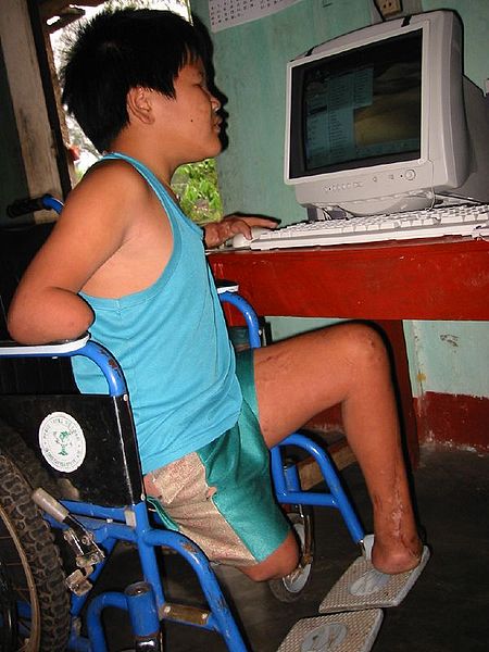 Unidentified Vietnamese landmine victim (Photo from Wikimedia Commons)