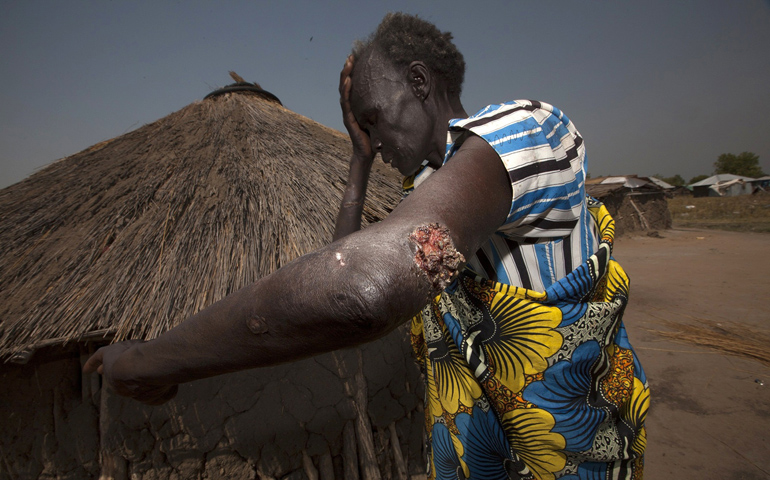 Deborah Awui shows a bullet wound she suffered during crossfire in her homestead in Bor, South Sudan, in this Jan. 27 photo. (CNS/Reuters/George Philipas)